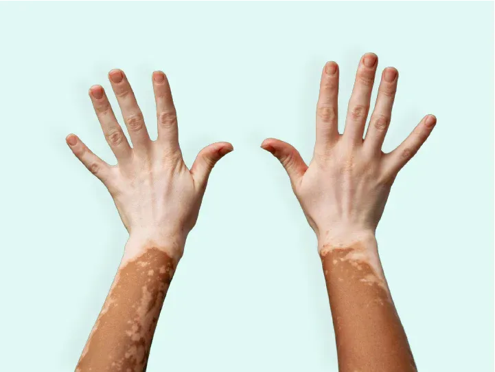 Causes of Vitiligo: Reveal the Factors of Skin Depigmentation