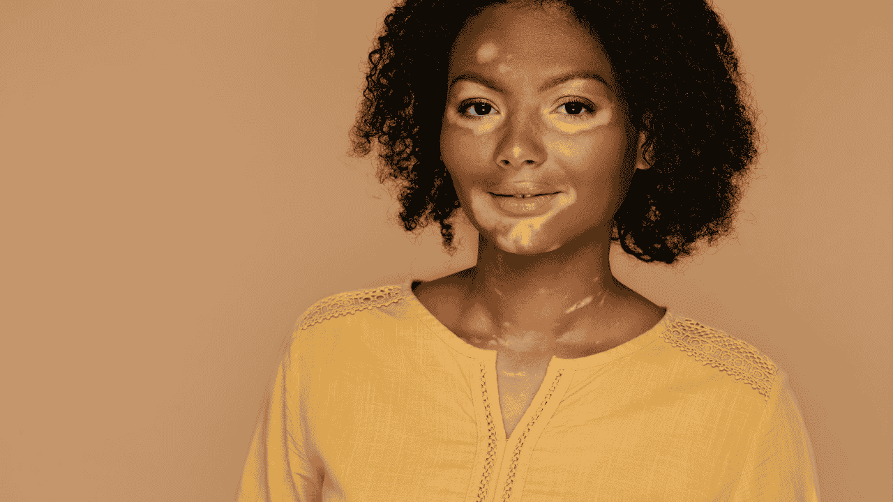 What is Vitiligo? A Complete Beginner’s Guide
