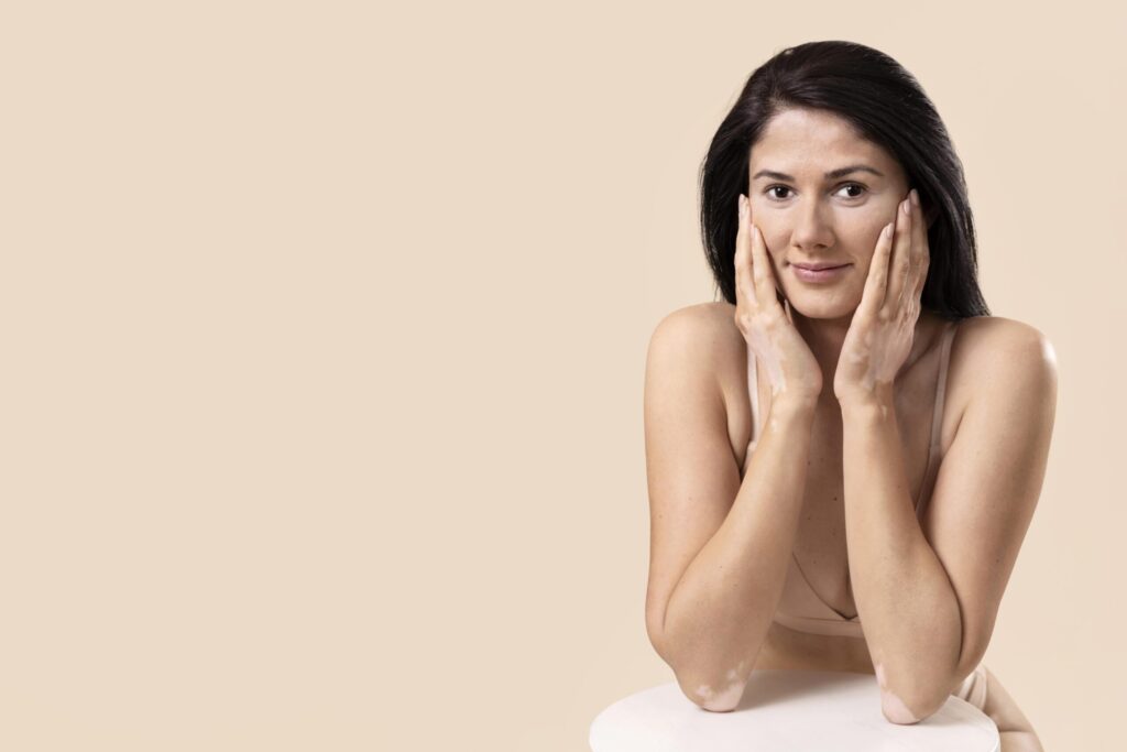Vitiligo causes
