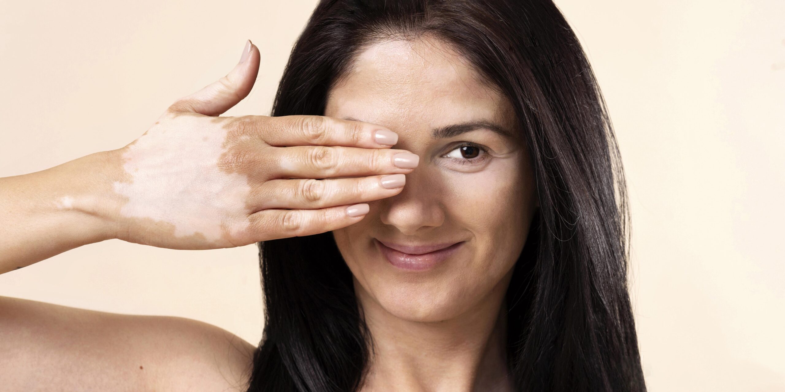 Vitiligo causes