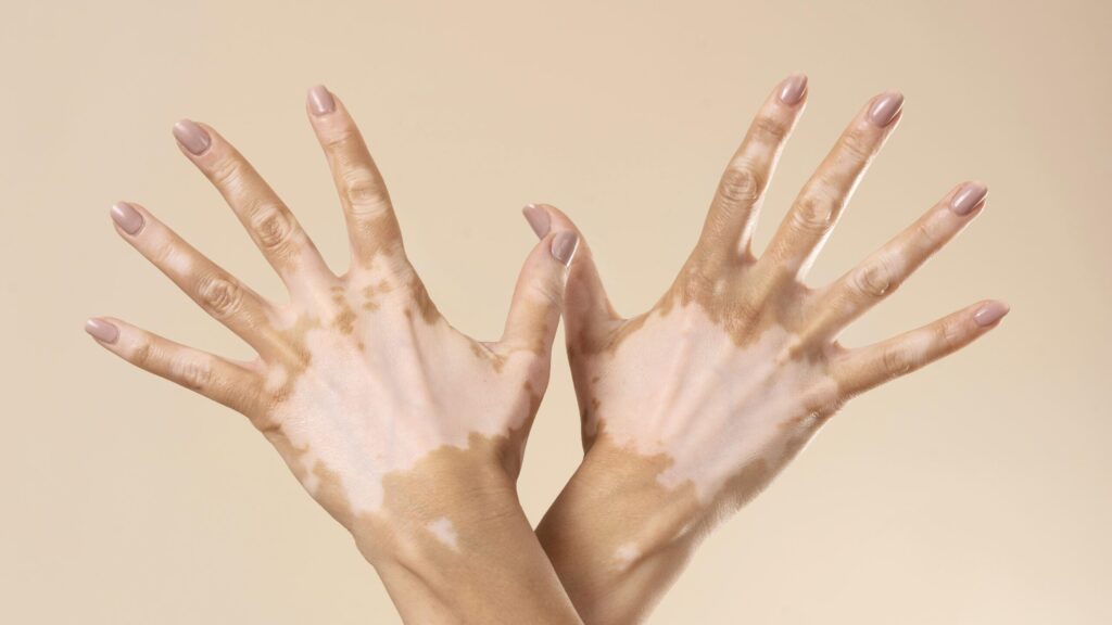 white people get vitiligo